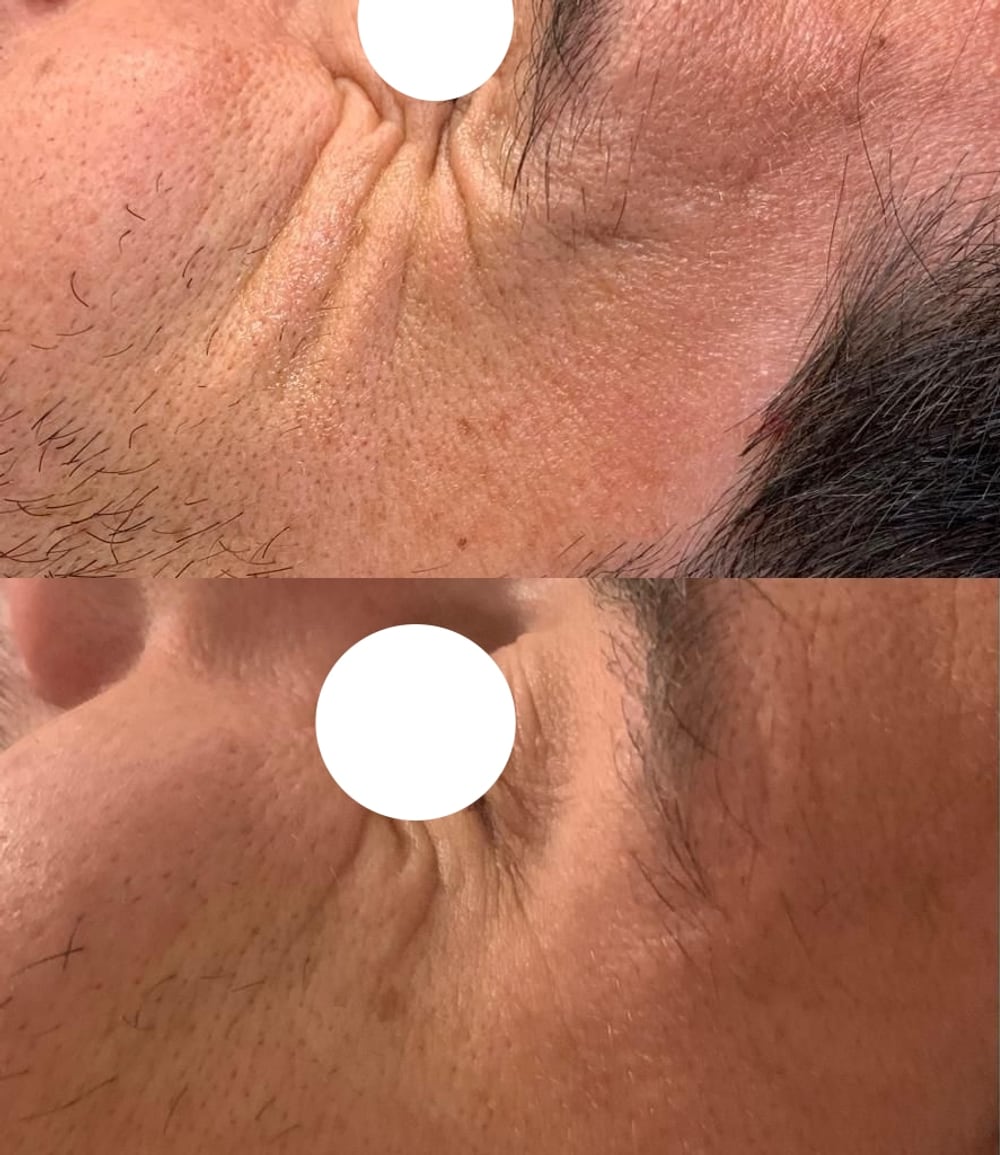Antes y después de un tratamiento de arrugas dinámicas perioculares realizado en Tricap, con el ojo del paciente cubierto