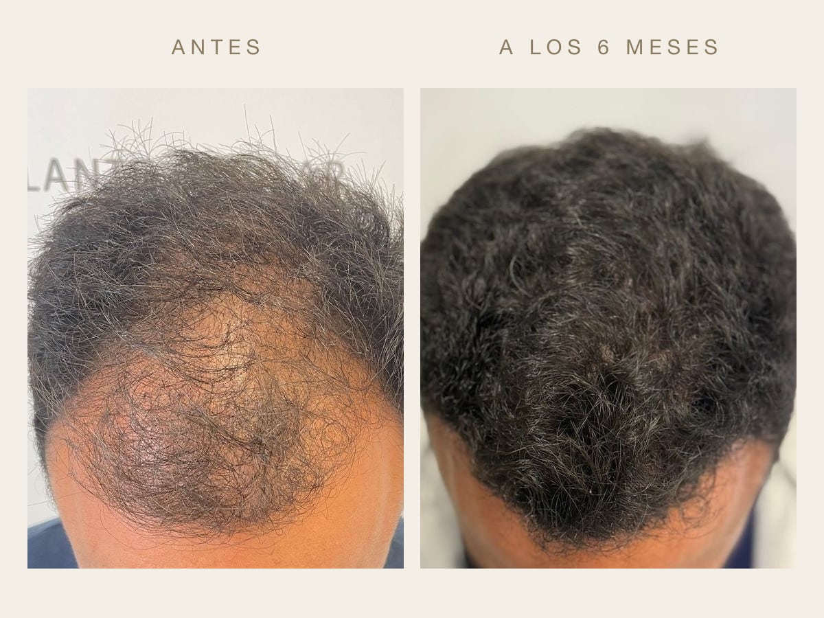 Antes y a los seis meses de un trasplante capilar realizado en Tricap, visto desde arriba