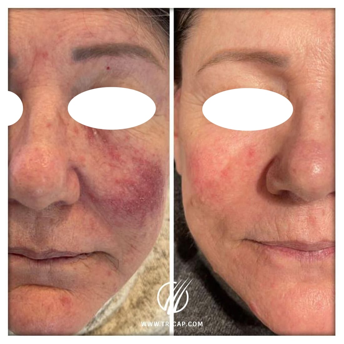 Antes y después de un tratamiento de rosácea realizado en Tricap, con los ojos de la paciente cubiertos