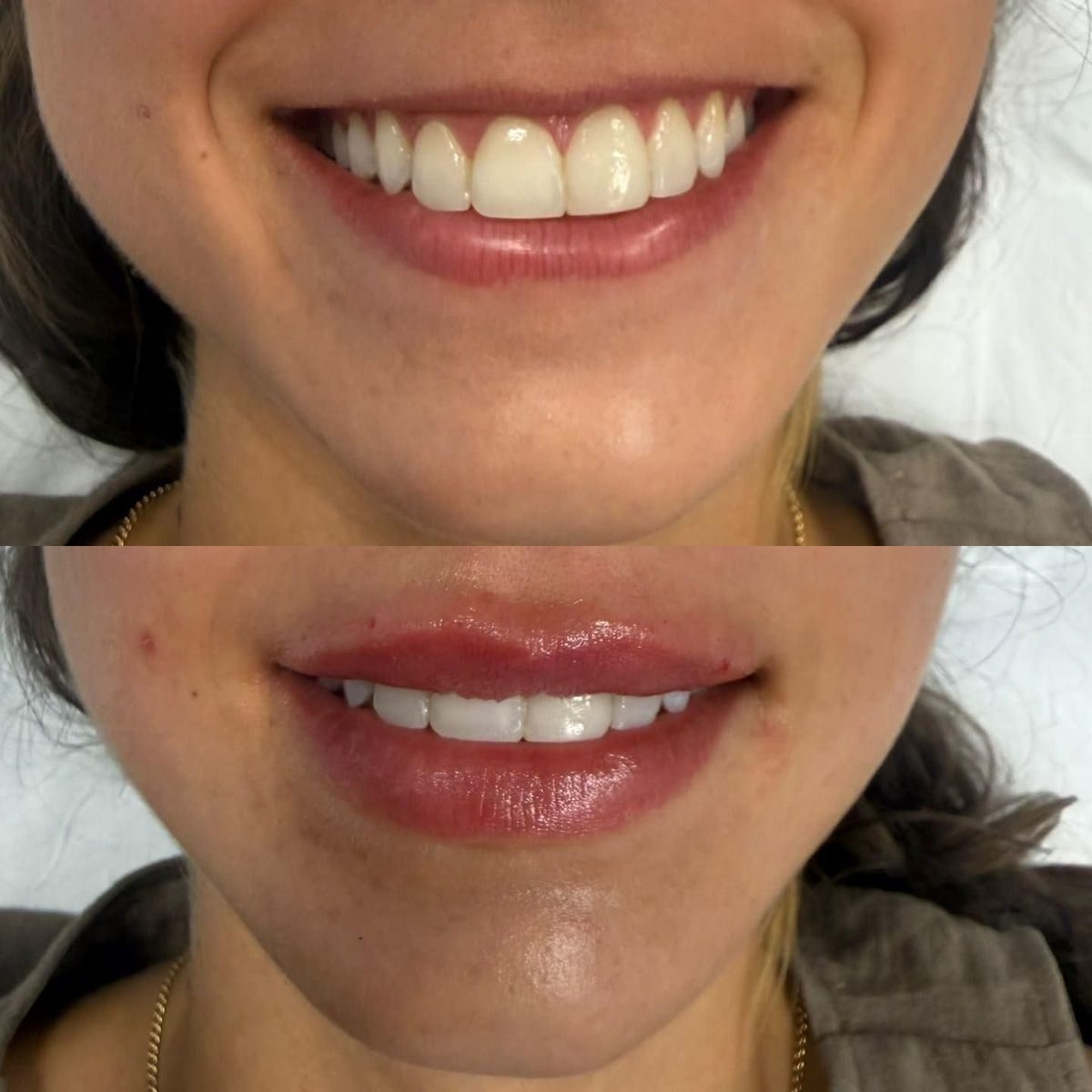 Antes y después de un aumento de labios realizado en Tricap