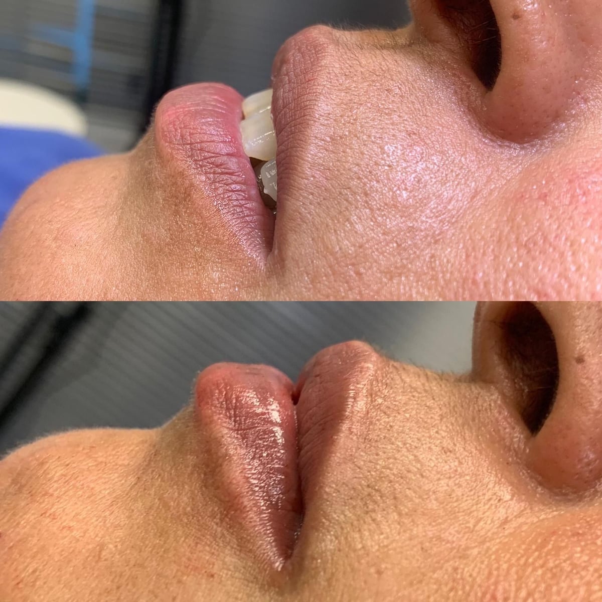 Antes y después de un aumento de labios realizado en Tricap, de perfil