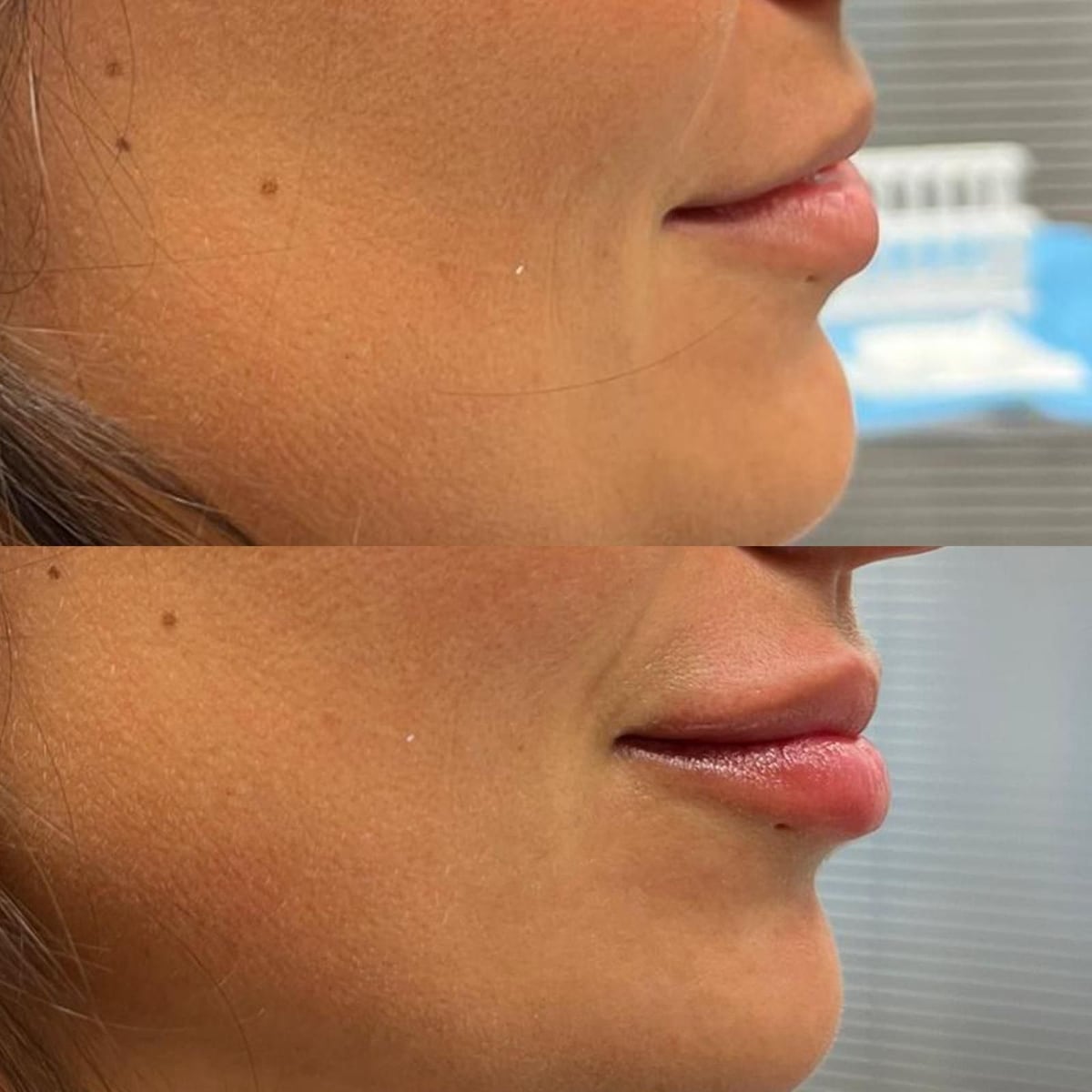 Antes y después de un aumento de labios realizado en Tricap, en tres cuartos