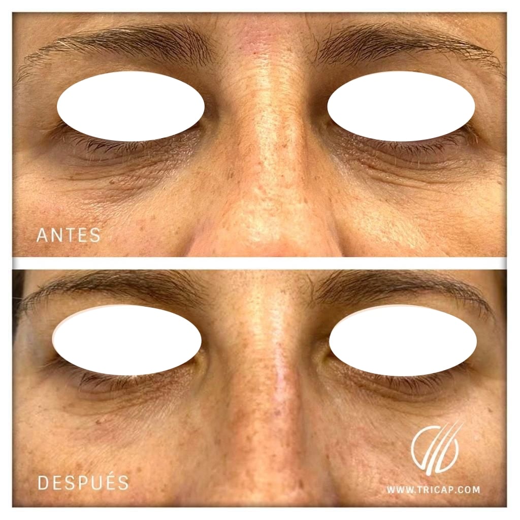 Antes y después de un tratamiento de ojeras realizado en Tricap, con los ojos de la paciente cubiertos