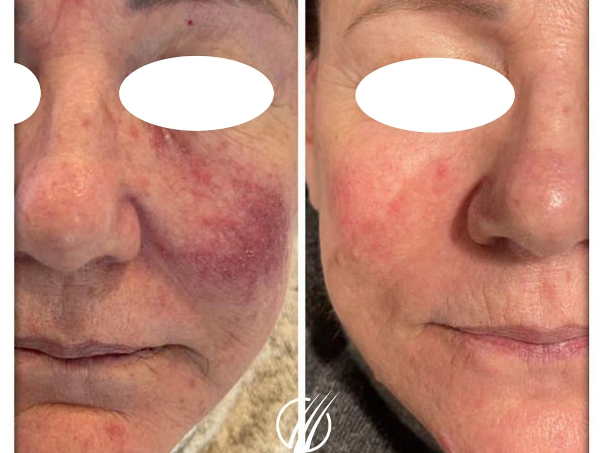Antes y después de un tratamiento de rosácea realizado en Tricap, con los ojos de la paciente cubiertos