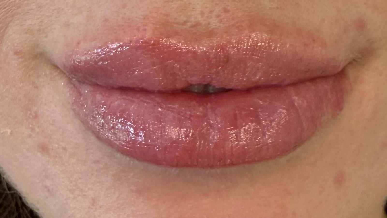 Resultado de un aumento de labios con ácido hialurónico realizado en Tricap