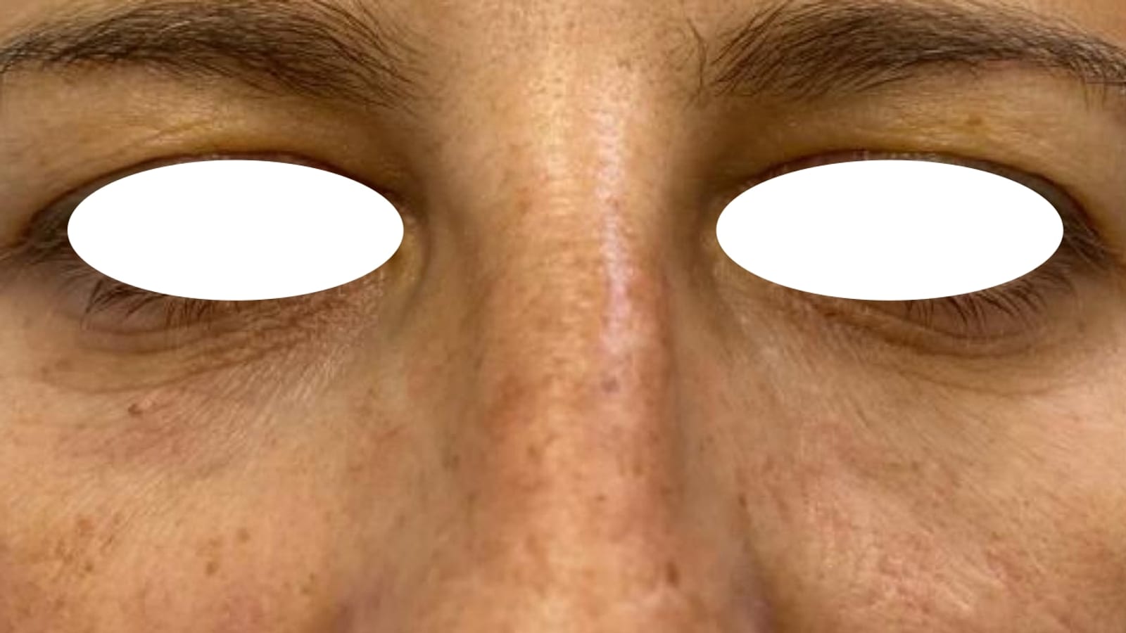 Resultado de un tratamiento de ojeras realizado en Tricap, con los ojos de la paciente cubiertos