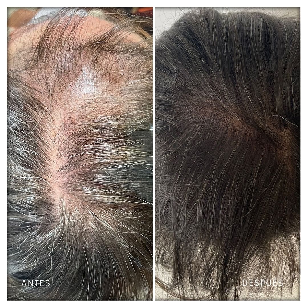 Antes y después de seis meses de tratamiento capilar en una alopecia androgenética, con la coronilla vista desde arriba