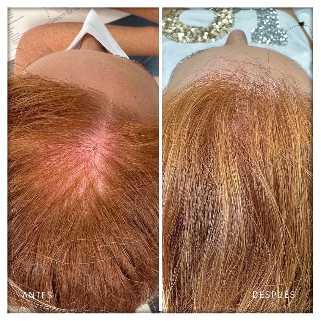 Antes y después de una dermatitis seborreica: la línea frontal recupera pelo una vez controlada la inflamación del cuero cabelludo