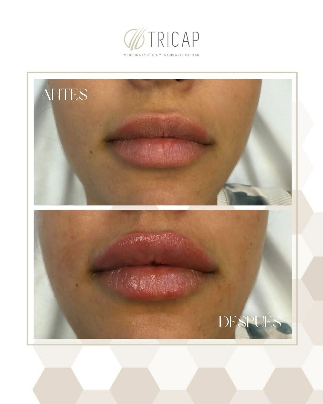 Antes y después de un tratamiento de labios, primer plano de la boca