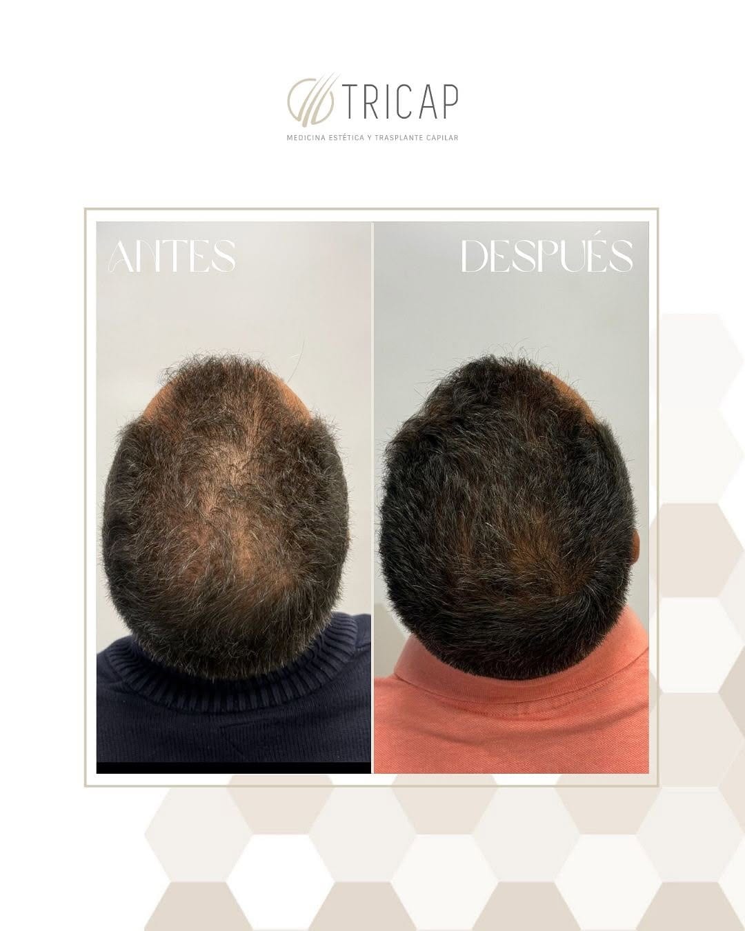 Antes y después de seis meses de tratamiento capilar, visto desde arriba