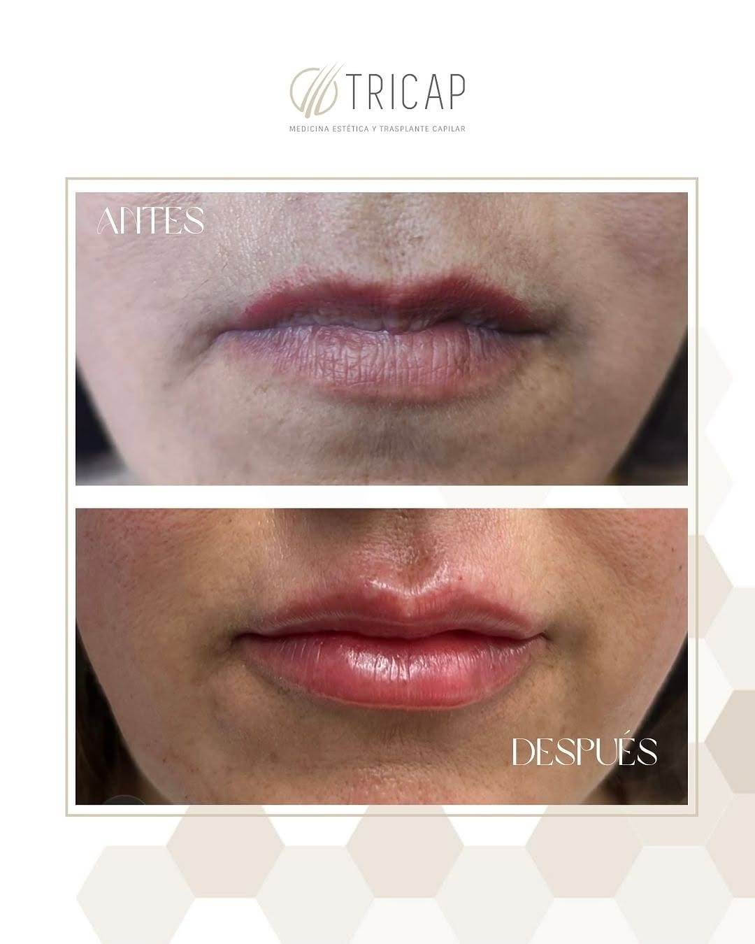 Antes y después de un aumento de labios con ácido hialurónico, primer plano de la boca