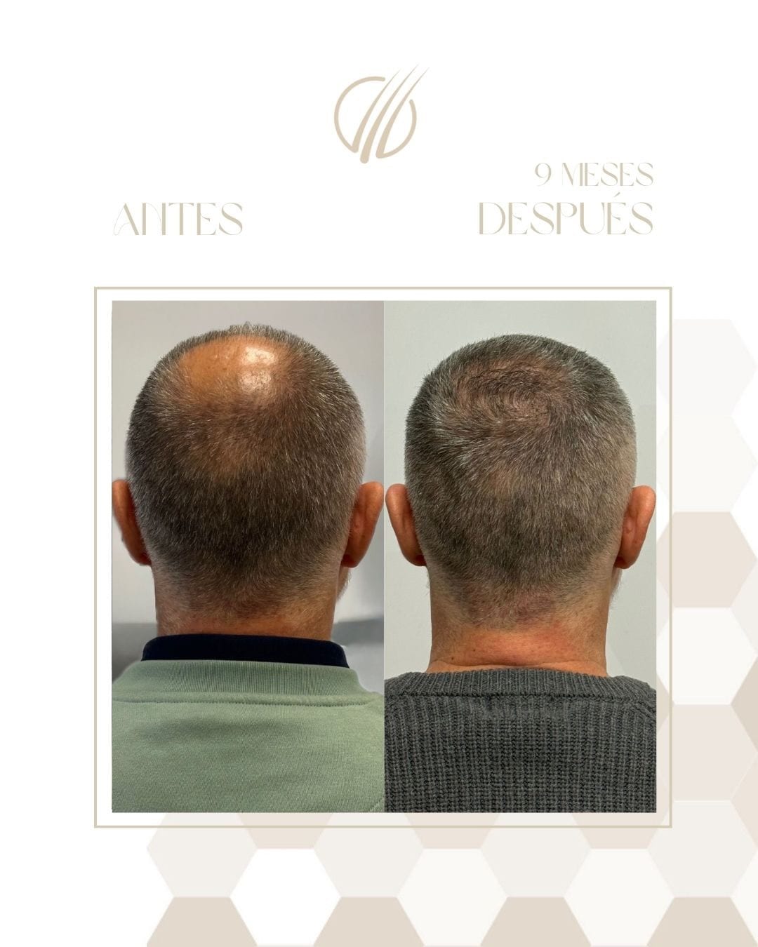 Antes y después de un trasplante capilar a los nueve meses, visto desde detrás