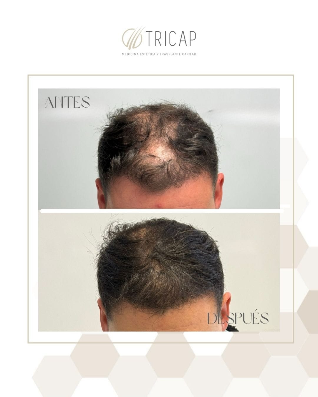Antes y después de un tratamiento capilar tras el diagnóstico, con la entrada frontal repoblada