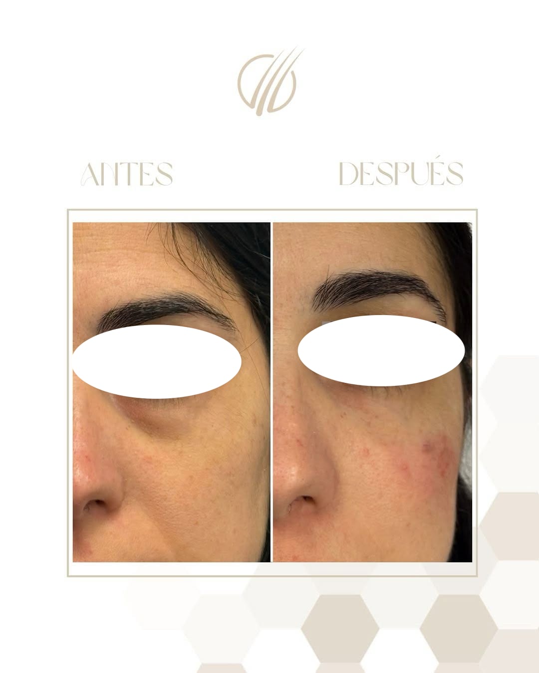 Antes y después inmediato de un tratamiento de ojeras, con la mirada cubierta