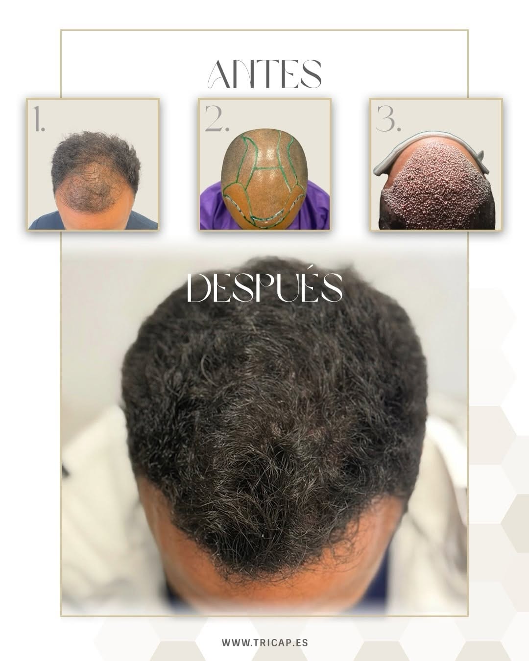 Antes y después de un trasplante capilar a los seis meses, con la línea frontal repoblada