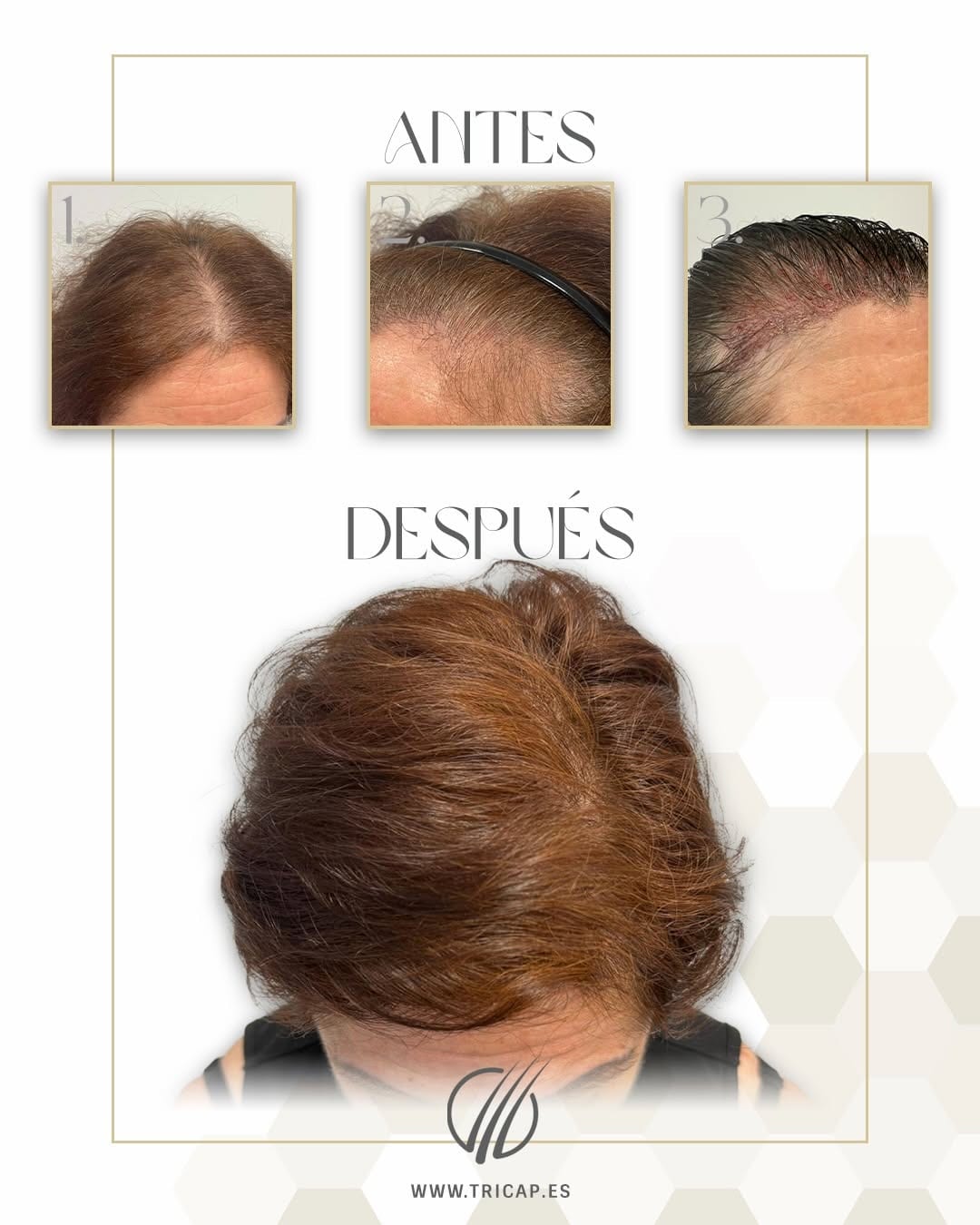Antes y después de un trasplante capilar en una paciente, con la zona frontal repoblada