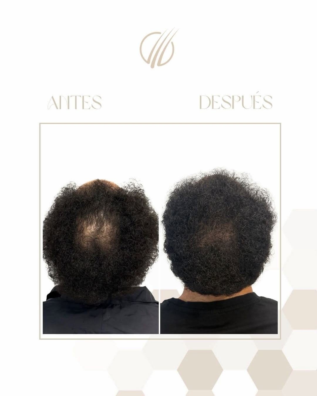 Antes y después de seis meses de tratamiento oral, con la coronilla más poblada