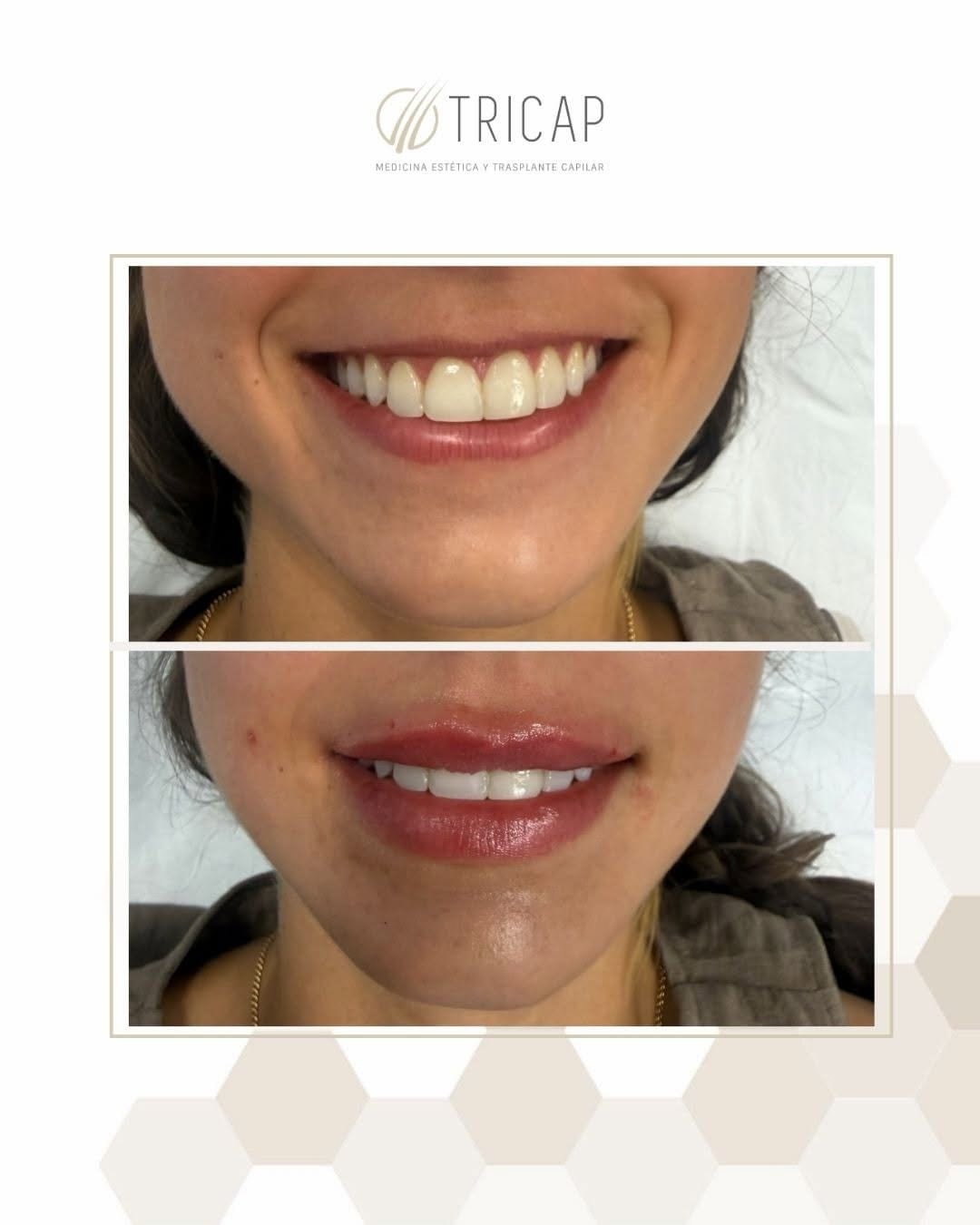 Antes y después de un tratamiento de labios, con la sonrisa en primer plano
