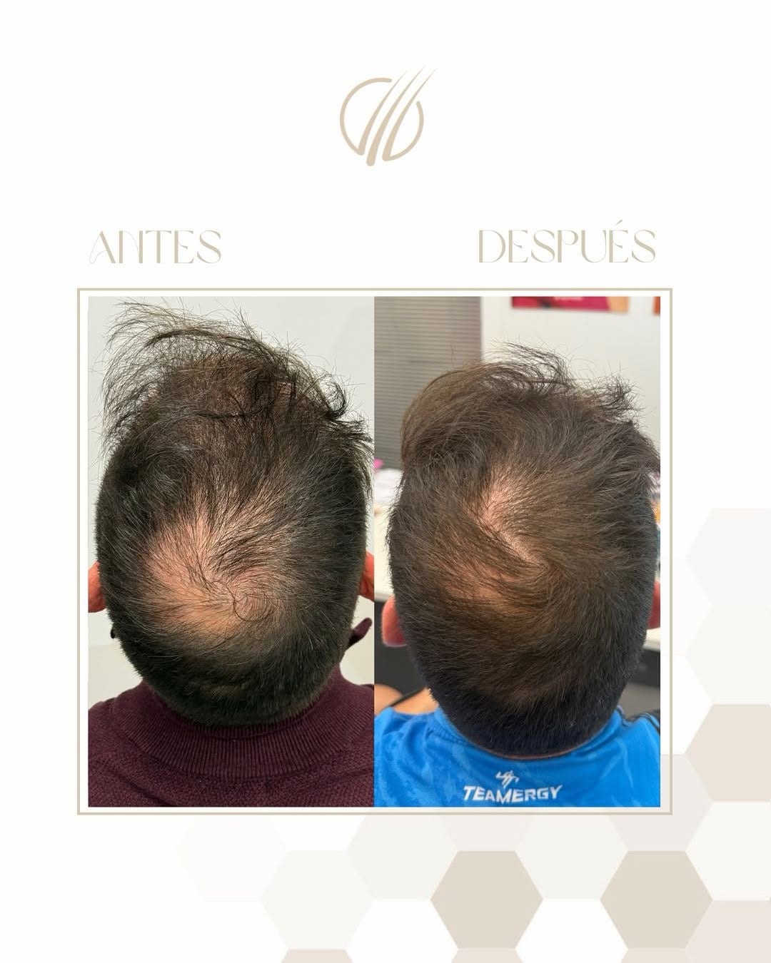 Antes y después de cuatro meses de tratamiento capilar, visto desde arriba